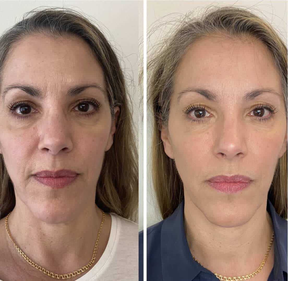 4 Treatments