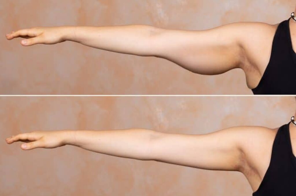 Amazing for Arms