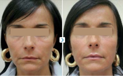Before & Immediately After 1 ChillTite