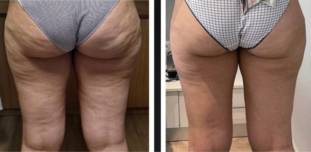 Works on Cellulite