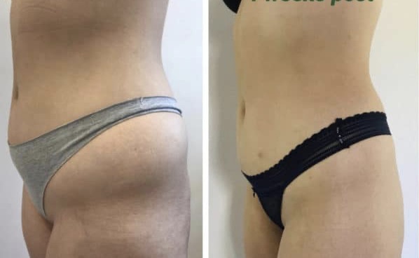 Before 1st ChillTitle - 4 Weeks After 1st Treatment