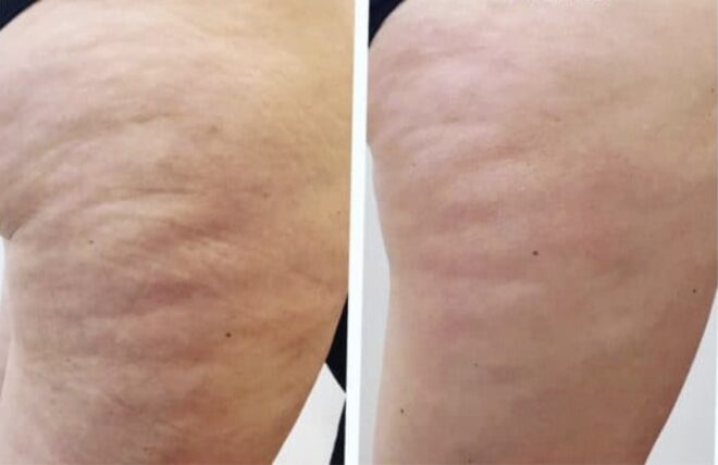 Before - After 1 Treatment 8 Weeks