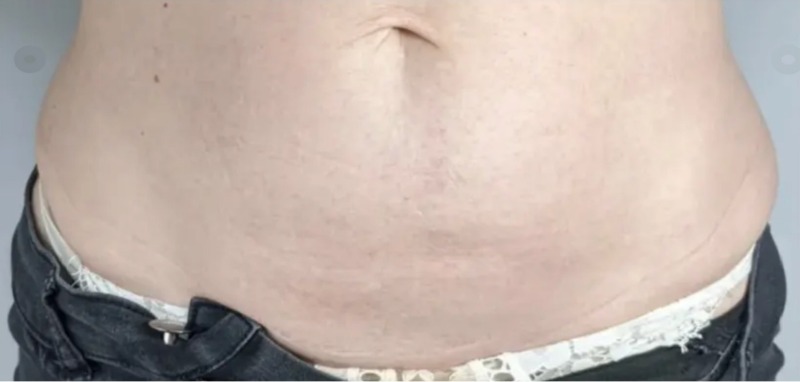 After 4 Months One Treatment