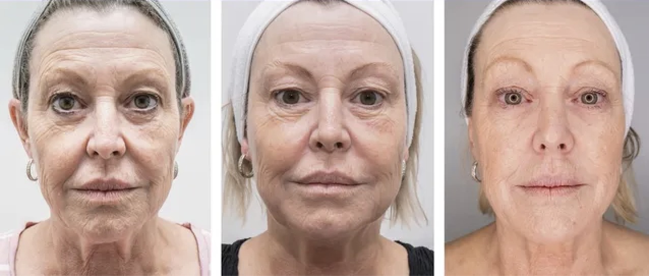Before - After 6 Weeks - After 26 Weeks