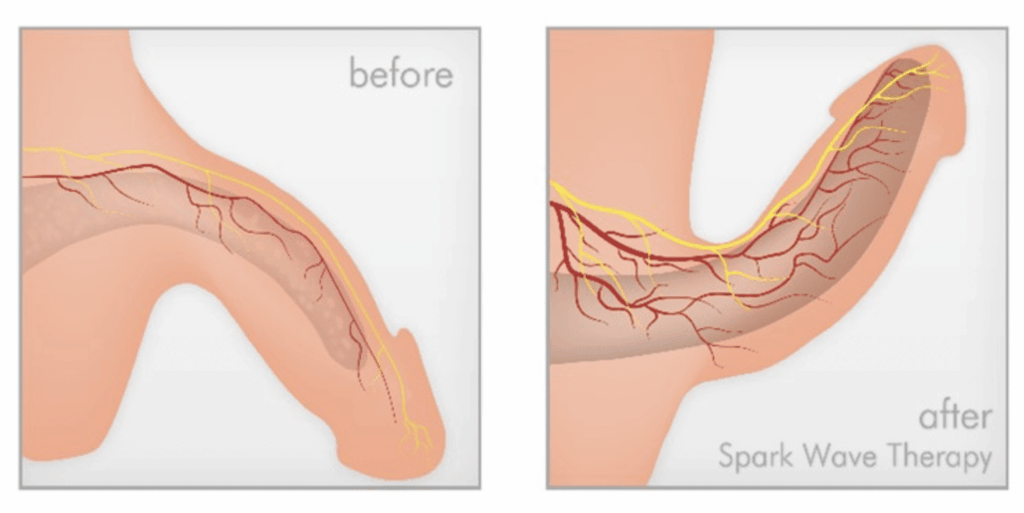Shockwave Therapy for ED