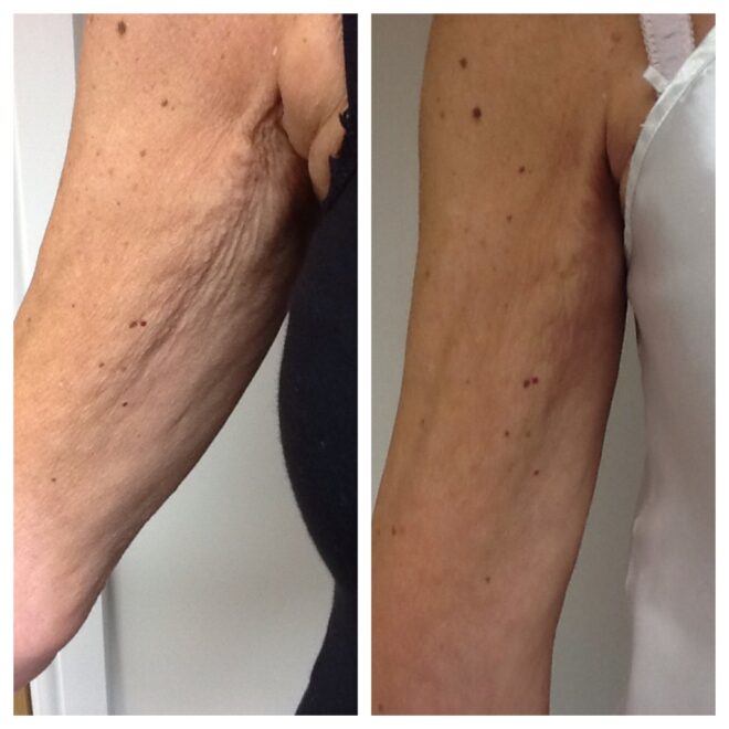 Before -> Axial puff, fat & crepey skin gone